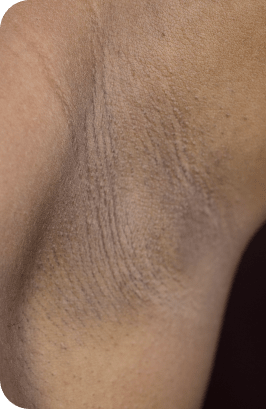 Laser hair removal underarms after one session